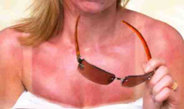 Sunburn Home Remedies from Organic Apoteke
