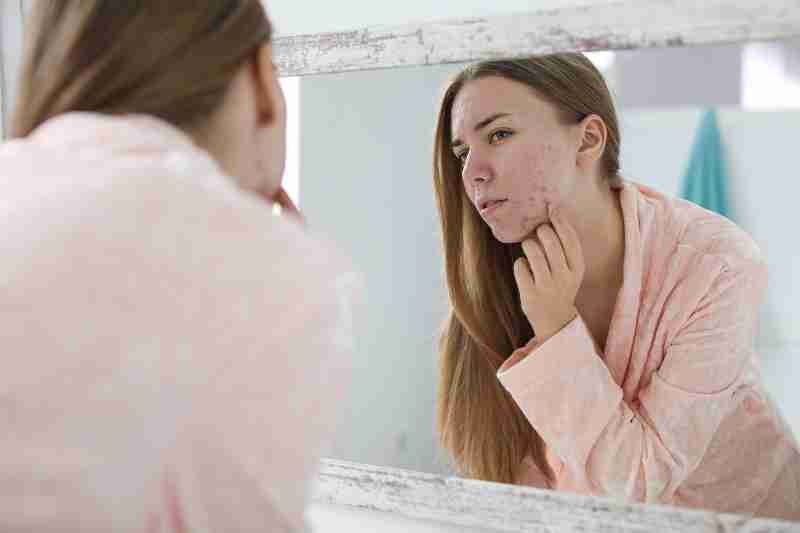 Woman looking at acne in the mirror