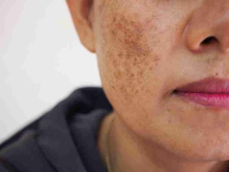 How Does Menopause Affect Skin Pigmentation Organic Apoteke