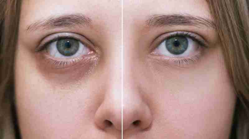 Woman with dark circles