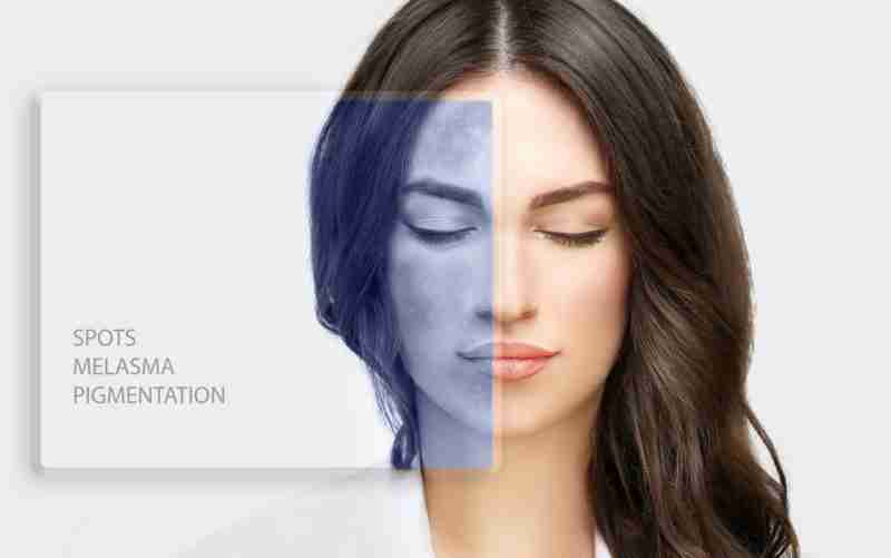 Solutions for Hyperpigmentation